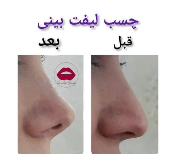 چسب لیفت بینی 3m آمریکایی اصل با چسبندگی بالا و نامرئی👃✨️🇺🇸